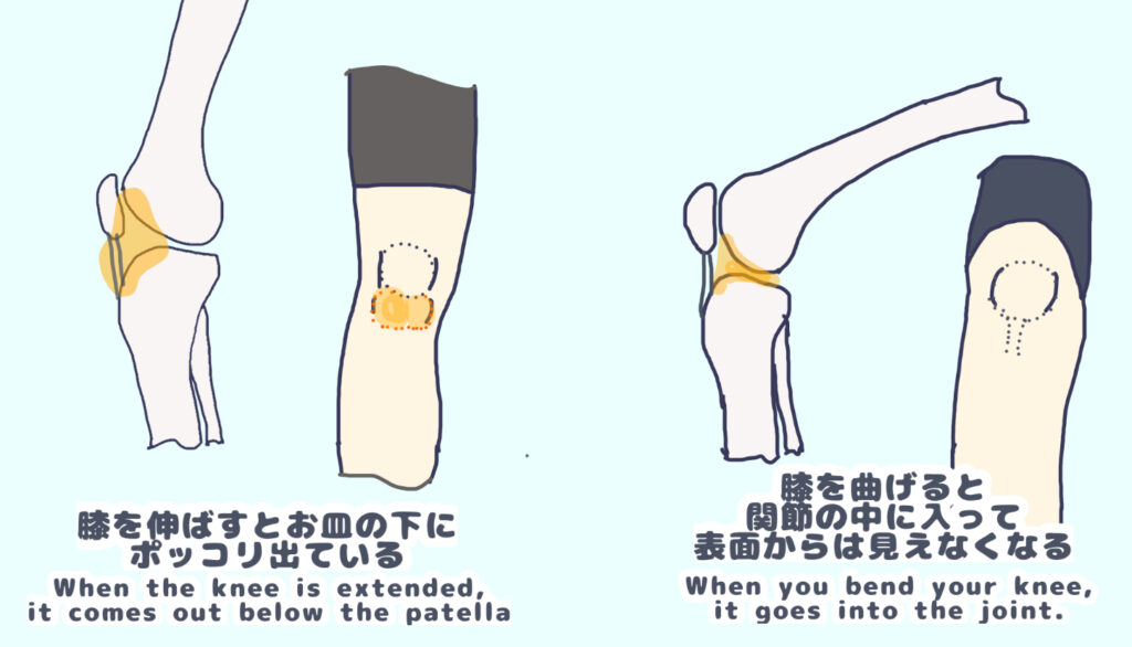 膝蓋下脂肪体は膝が伸展していると、関節の外にあり、屈曲すると関節の中にしまわれる