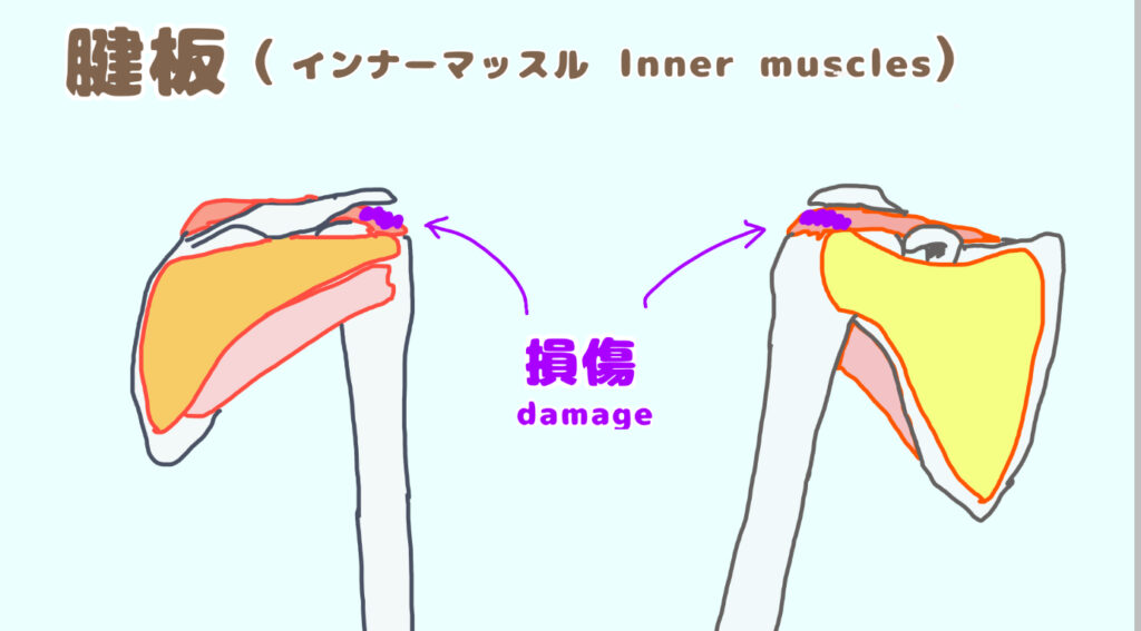 肩のインナーマッスルの腱が損傷している