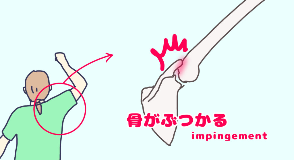 右肩を上げたときにインピンジメント症候群が発生している