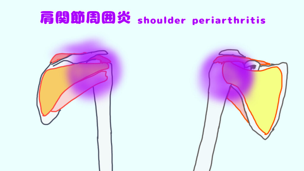 肩関節周囲炎のイメージ
