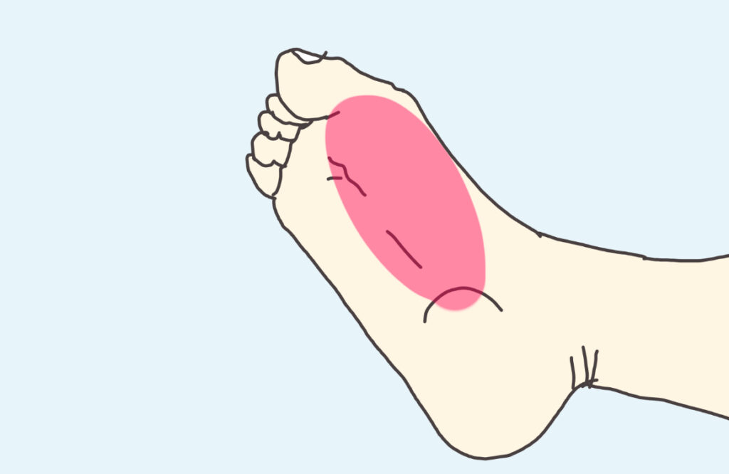 足裏のすこし内側がつることも多い