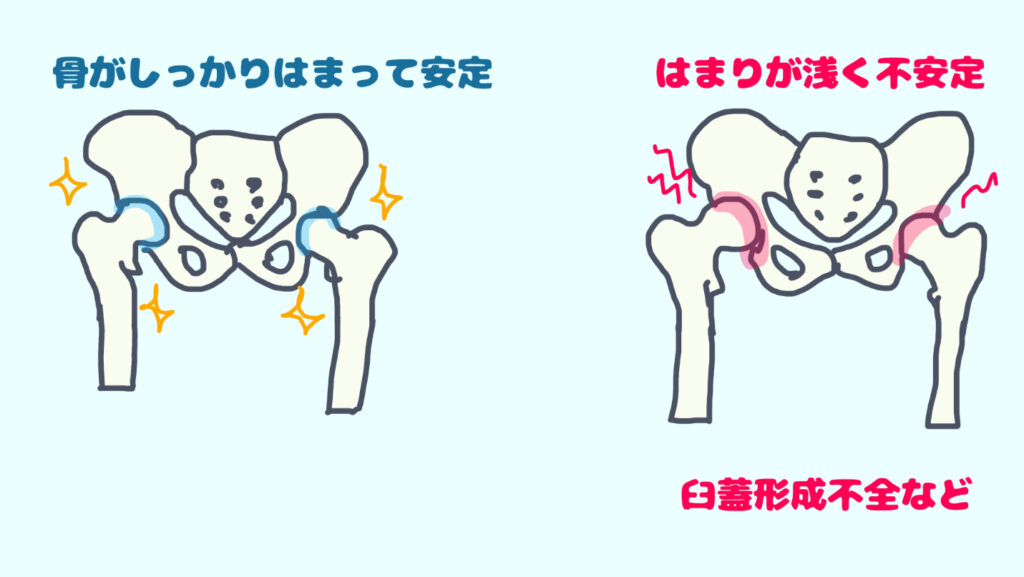 臼蓋形成不全があると股関節は不安定になりやすい