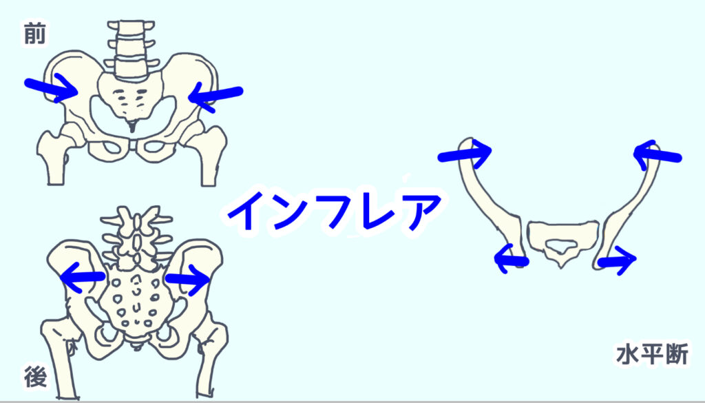 仙腸関節のインフレアを説明している