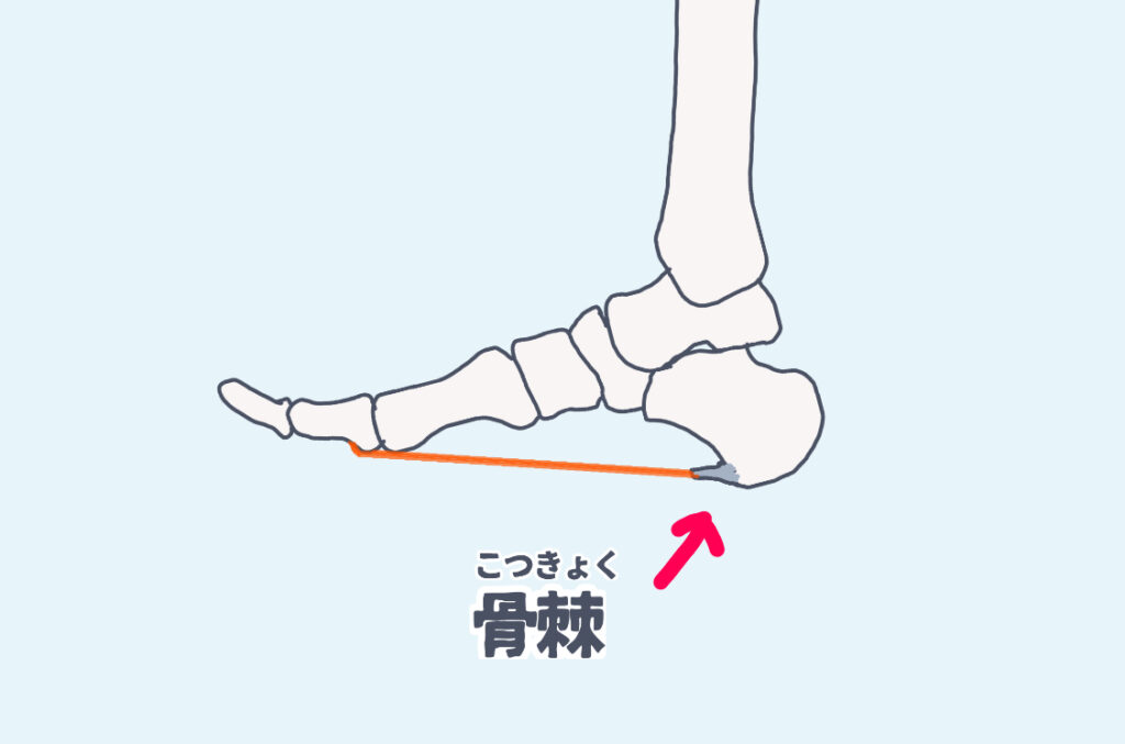 踵の足底側に骨棘が出来ている