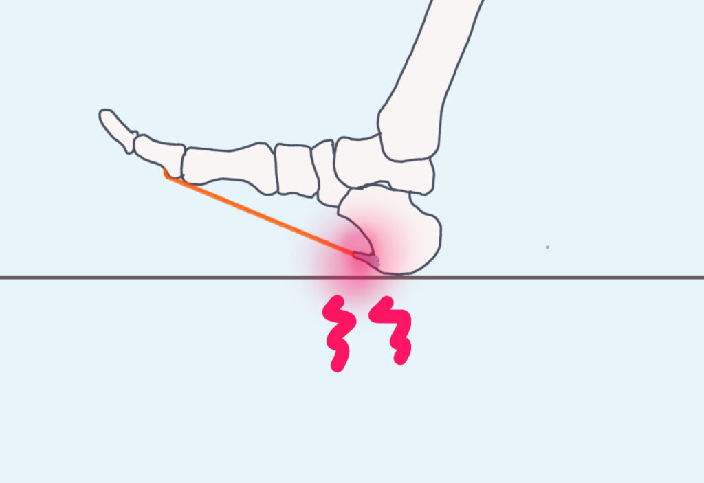 踵の骨棘が着地の衝撃で痛みを出している