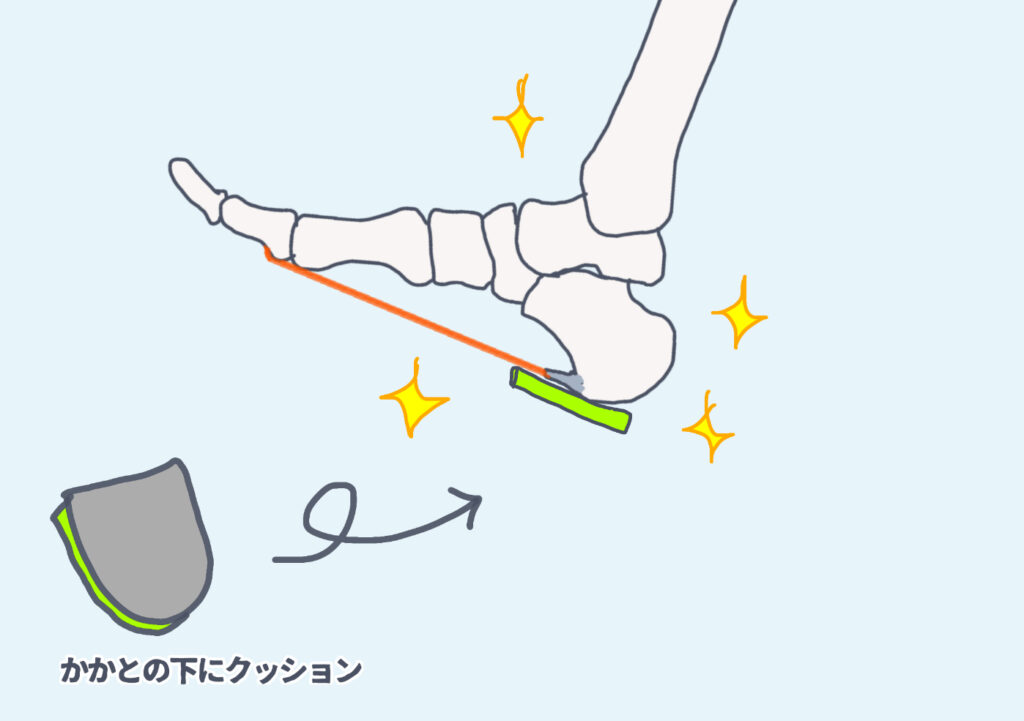 踵の下にクッションを入れて骨棘の痛みが和らいでいる