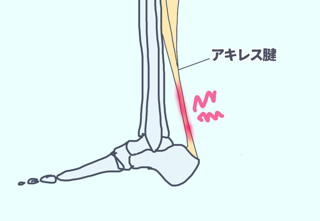 アキレス腱自体が痛みを発生している