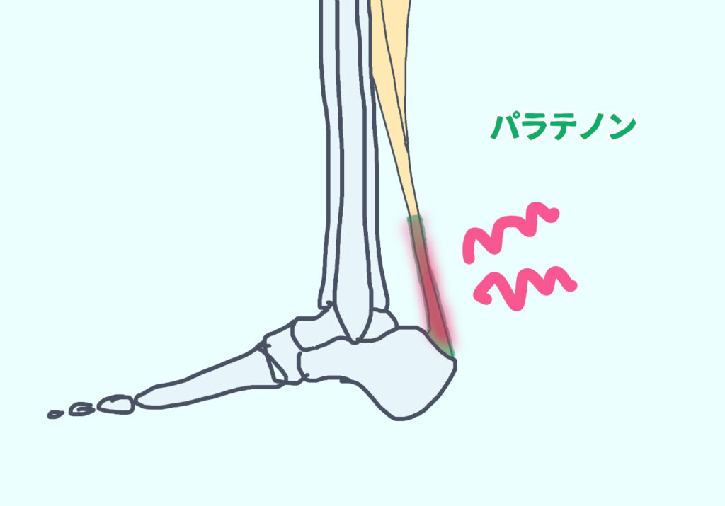 パラテノンの痛み