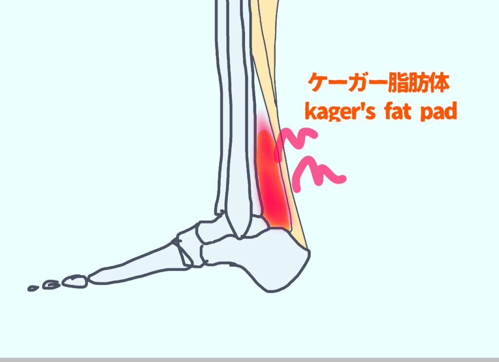 ケーガー脂肪体の痛み