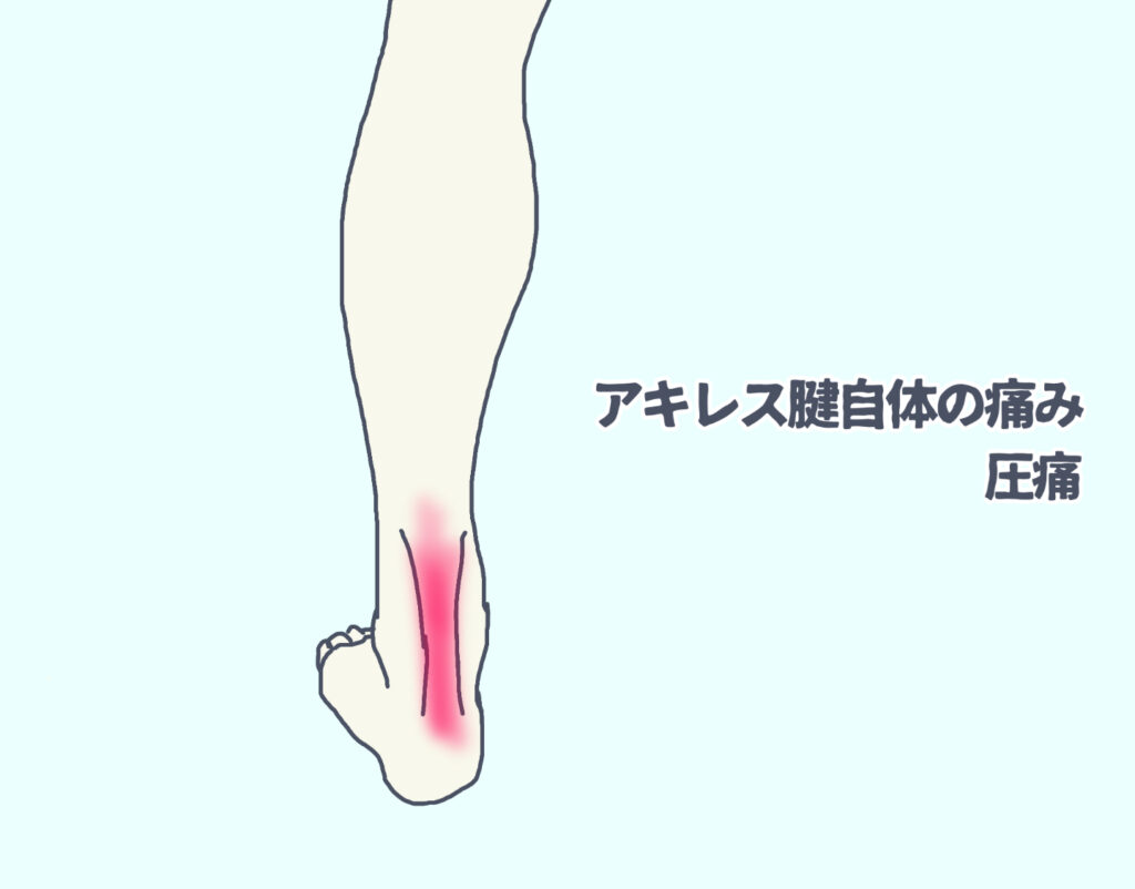アキレス腱の圧痛