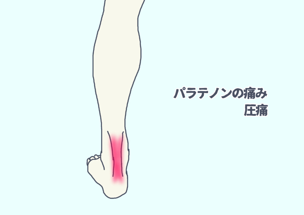 パラテノンの圧痛　アキレス腱自体の痛みとオーバーラップする