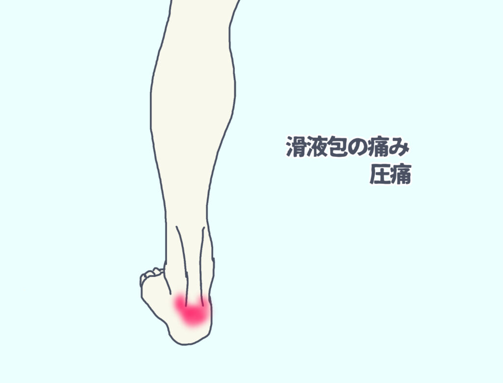 アキレス腱周囲の滑液包が痛い場合に圧痛がある場所