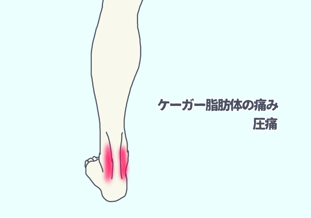 ケーガー脂肪体に痛みがある時に圧痛がある場所
