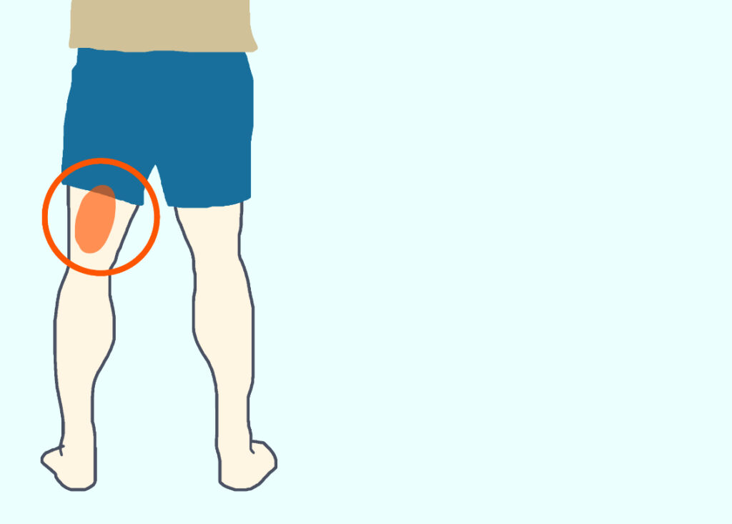 ハムストリングの中に硬結がある