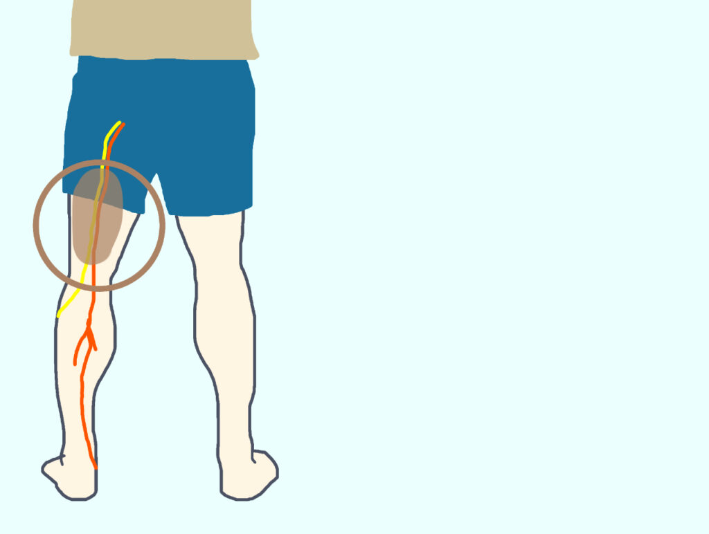 坐骨神経とハムストリングの間の滑走障害