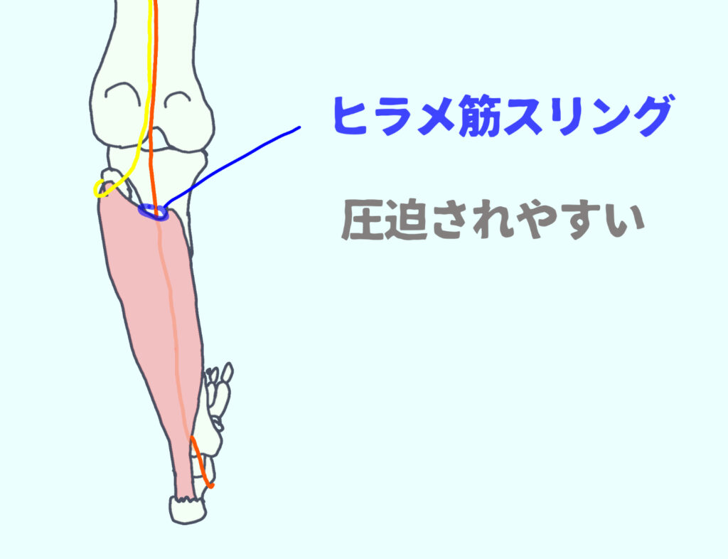 ヒラメ筋スリングの部分で脛骨神経が圧迫されやすい