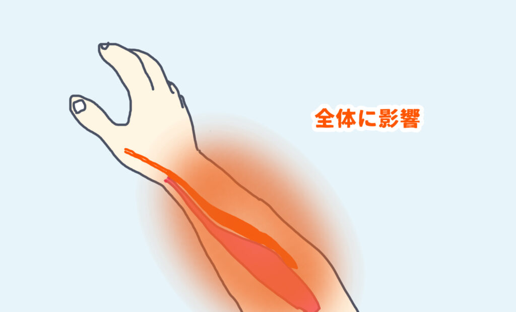 ①長母指外転筋と②短母指伸筋だけでなく周辺の筋・筋膜にも影響は及ぶ