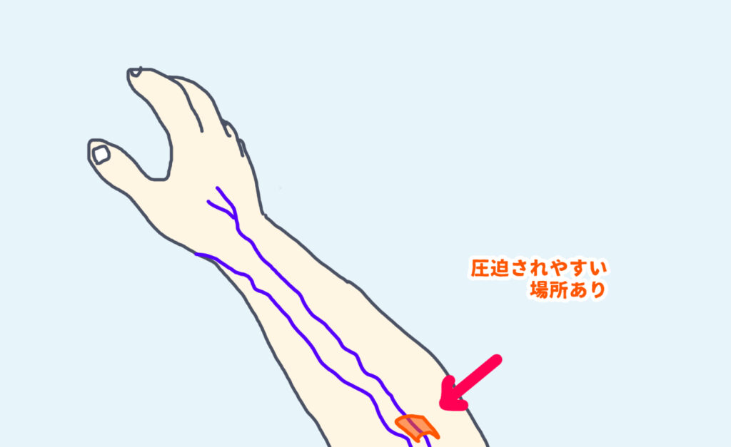 橈骨神経は肘の少し下で圧迫されやすい場所がある